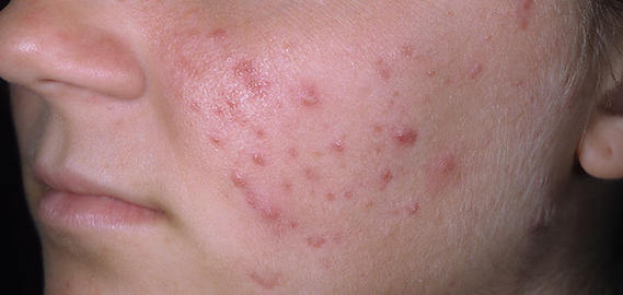 Controlling acne